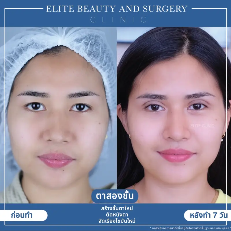 ตา 2 ชั้น