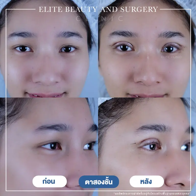 ตา 2 ชั้น 