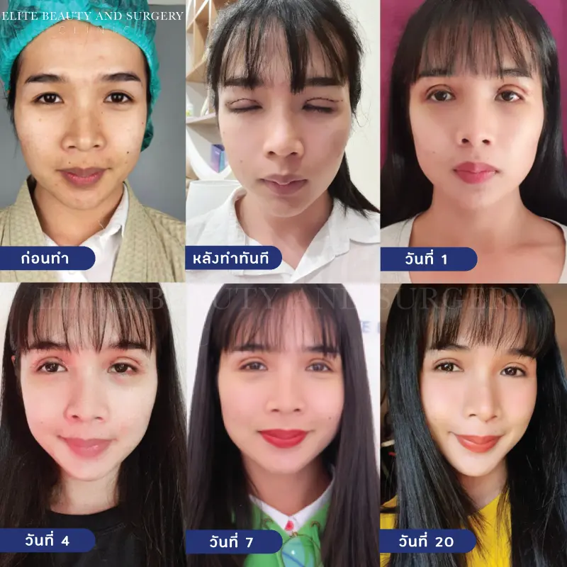 ตา 2 ชั้น 