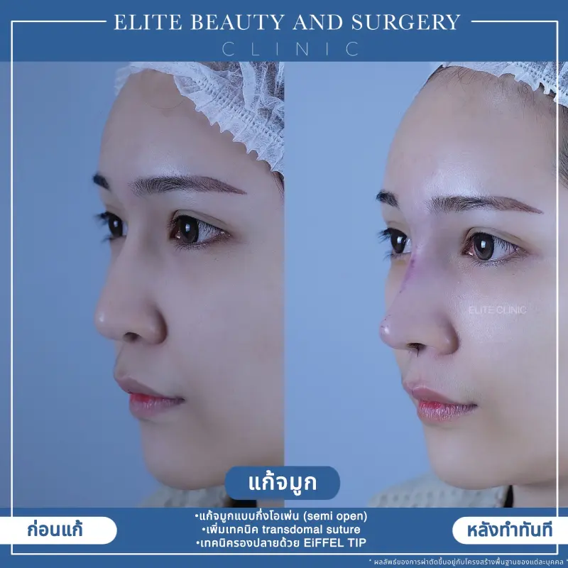 เสริมจมูก