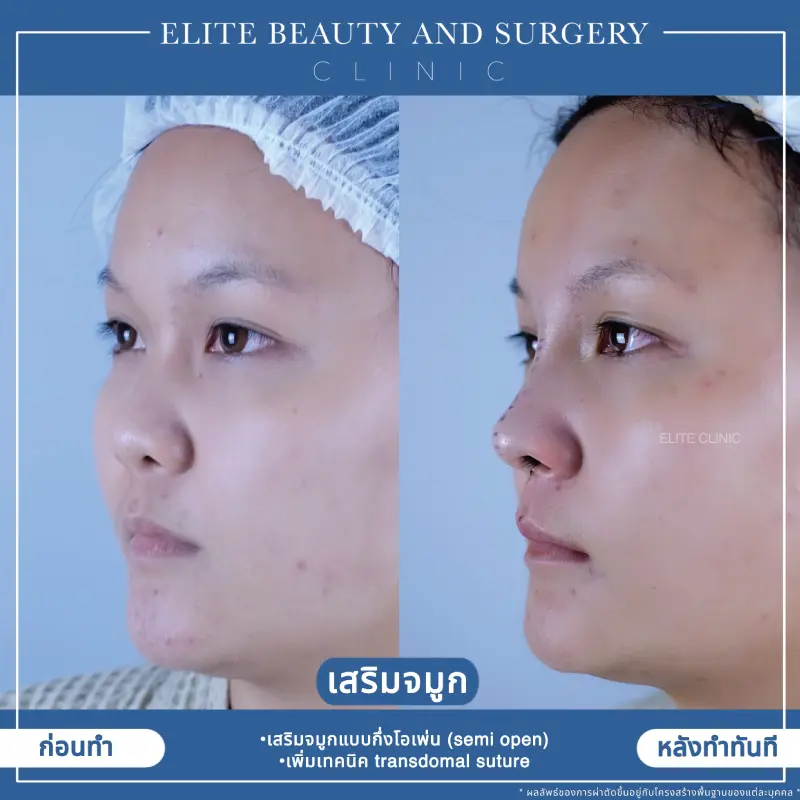 เสริมจมูก