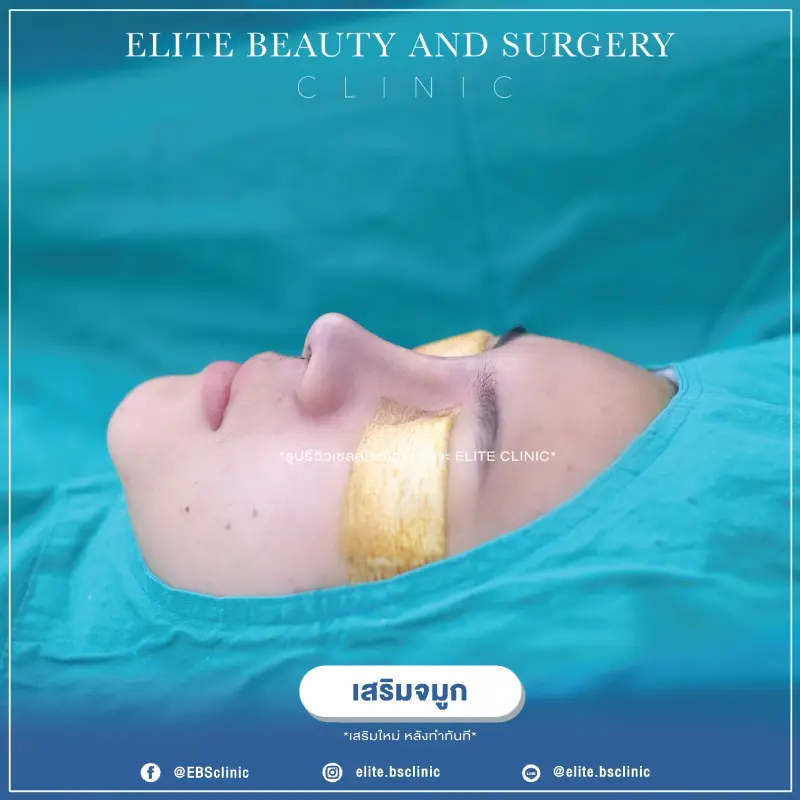 เสริมจมูก