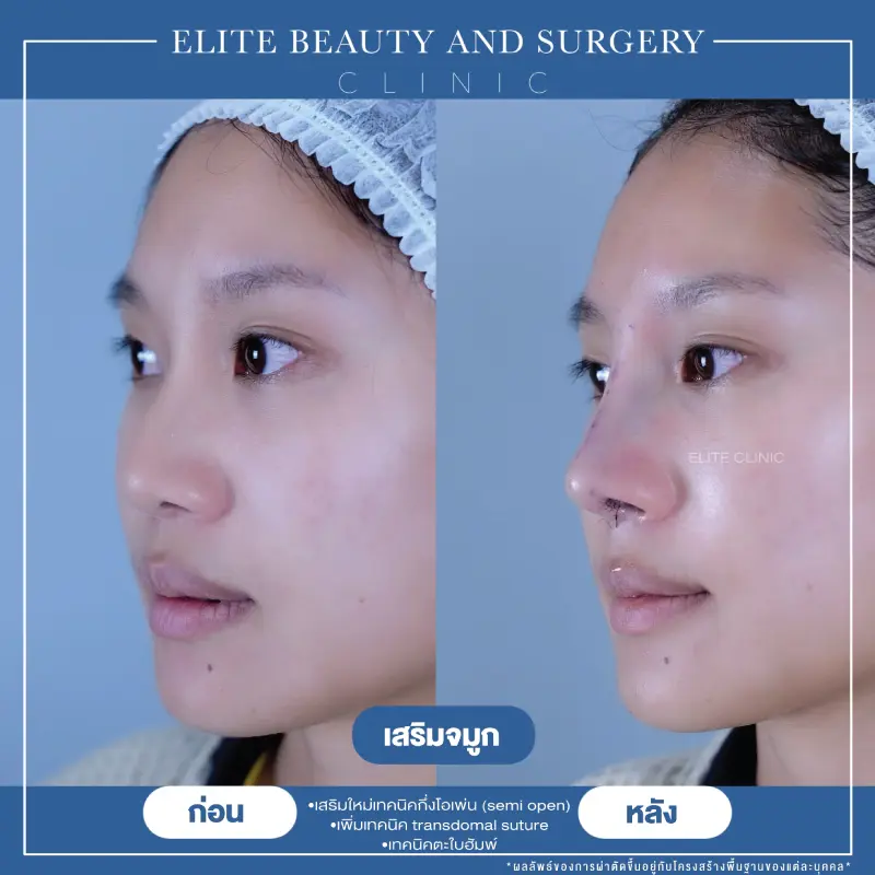 เสริมจมูก