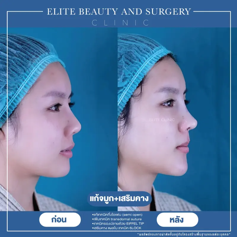 เสริมจมูก