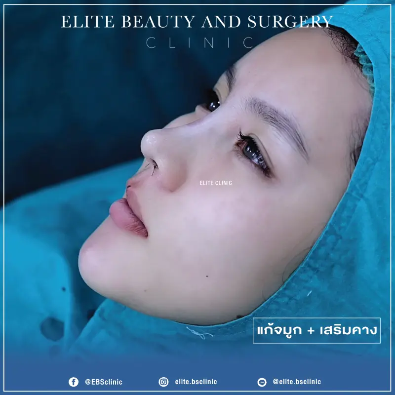 เสริมจมูก