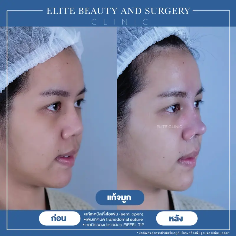 เสริมจมูก