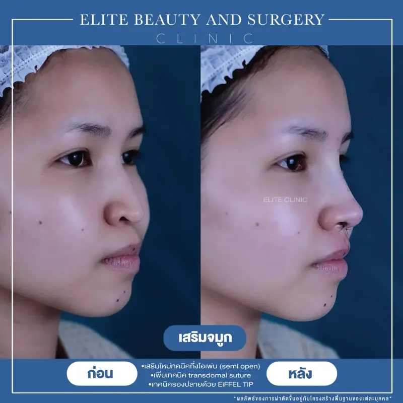 เสริมจมูก