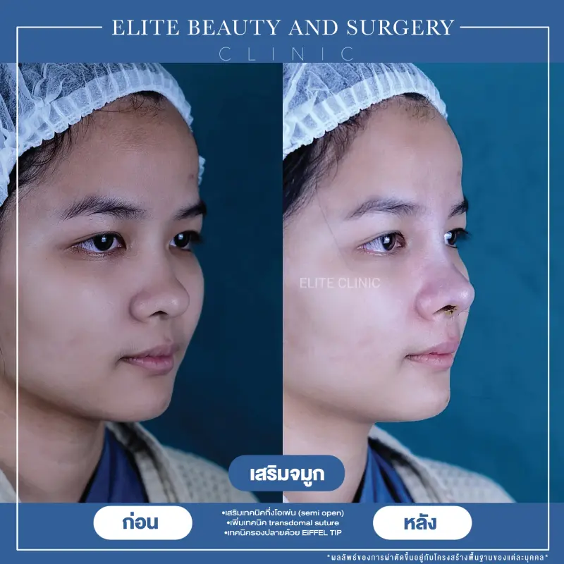 เสริมจมูก