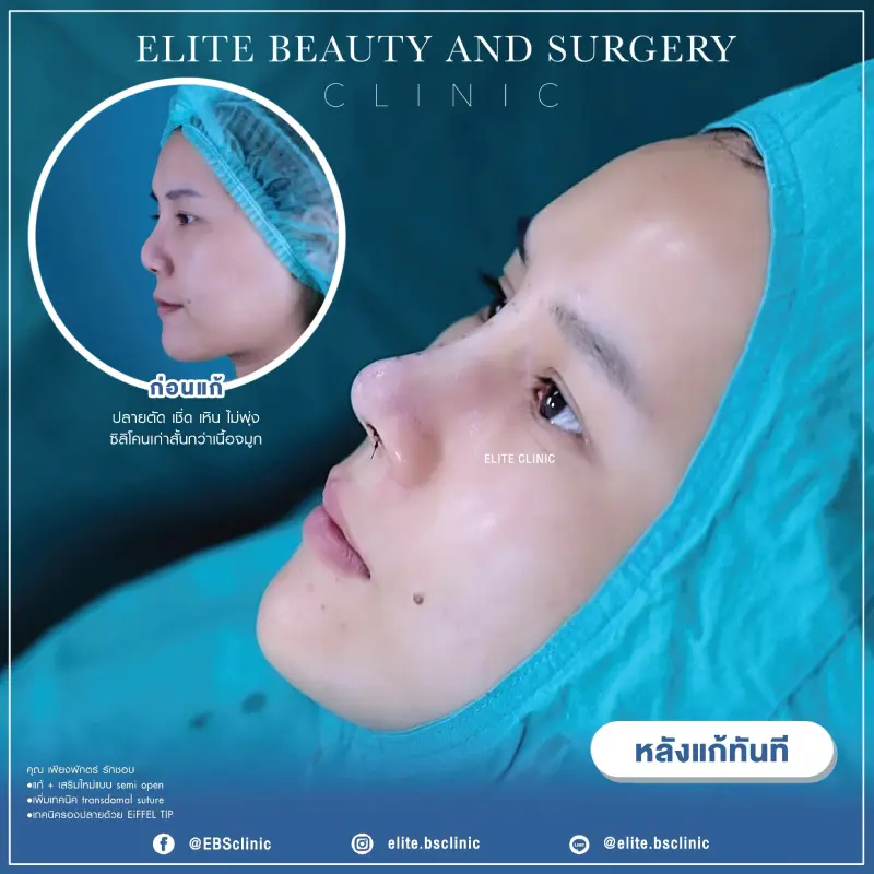 เสริมจมูก