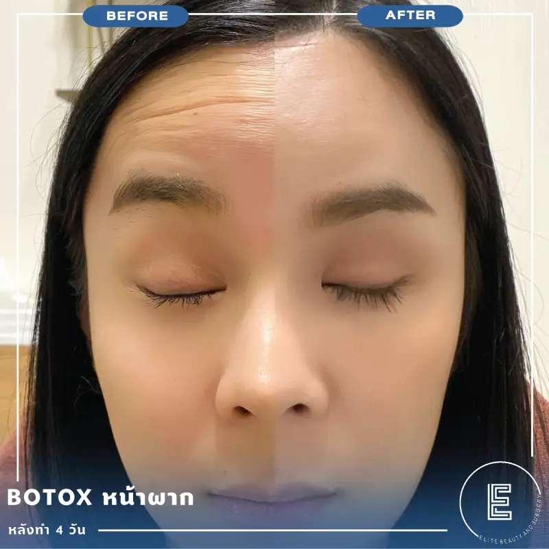 Botox หน้าผาก