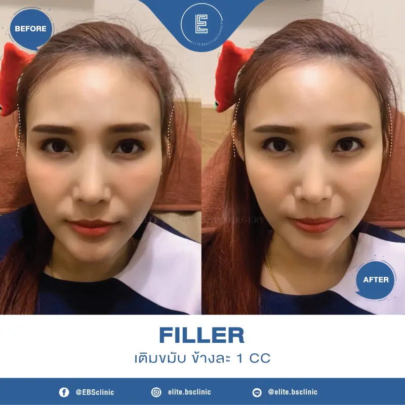 Filler เติมขมับ