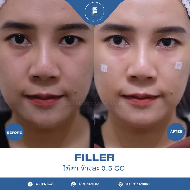 Filler ใต้ตา