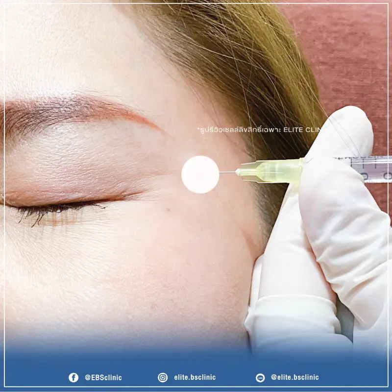 Botox ริ้วรอย