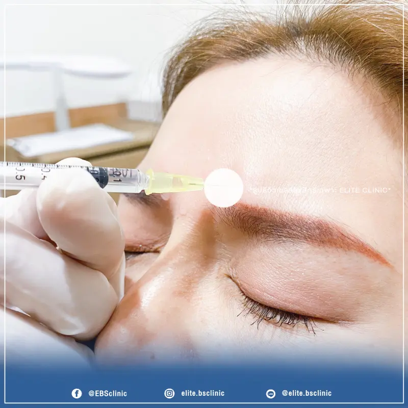 Botox หว่างคิ้ว