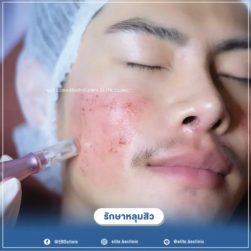 รักษาหลุมสิว