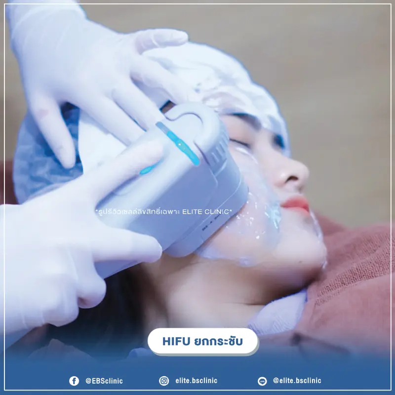 Hifu ยกกระชับ