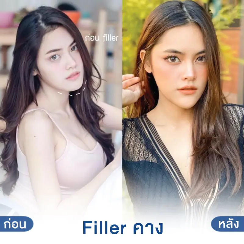 Filler คาง