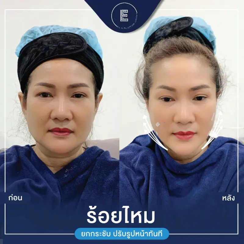 ร้อยไหม