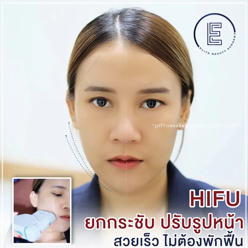 Hifu ยกกระชับ