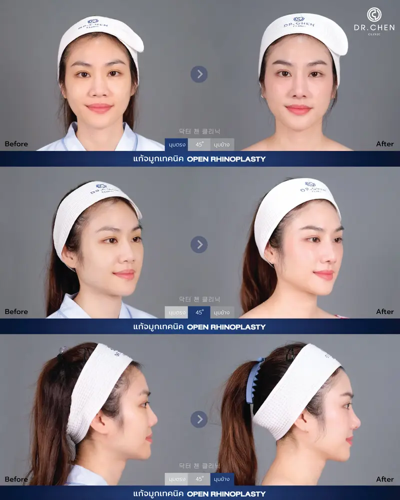 Revision Open Rhinoplasty