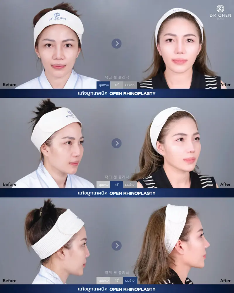 Revision Open Rhinoplasty