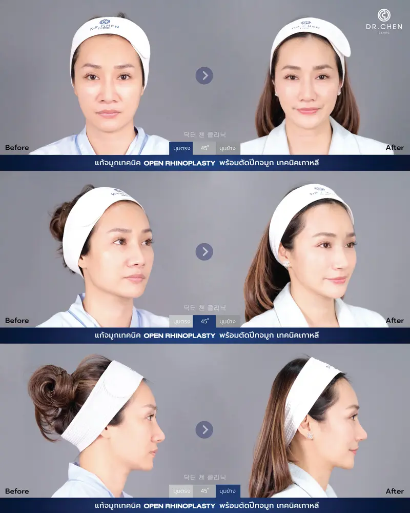 Revision Open Rhinoplasty