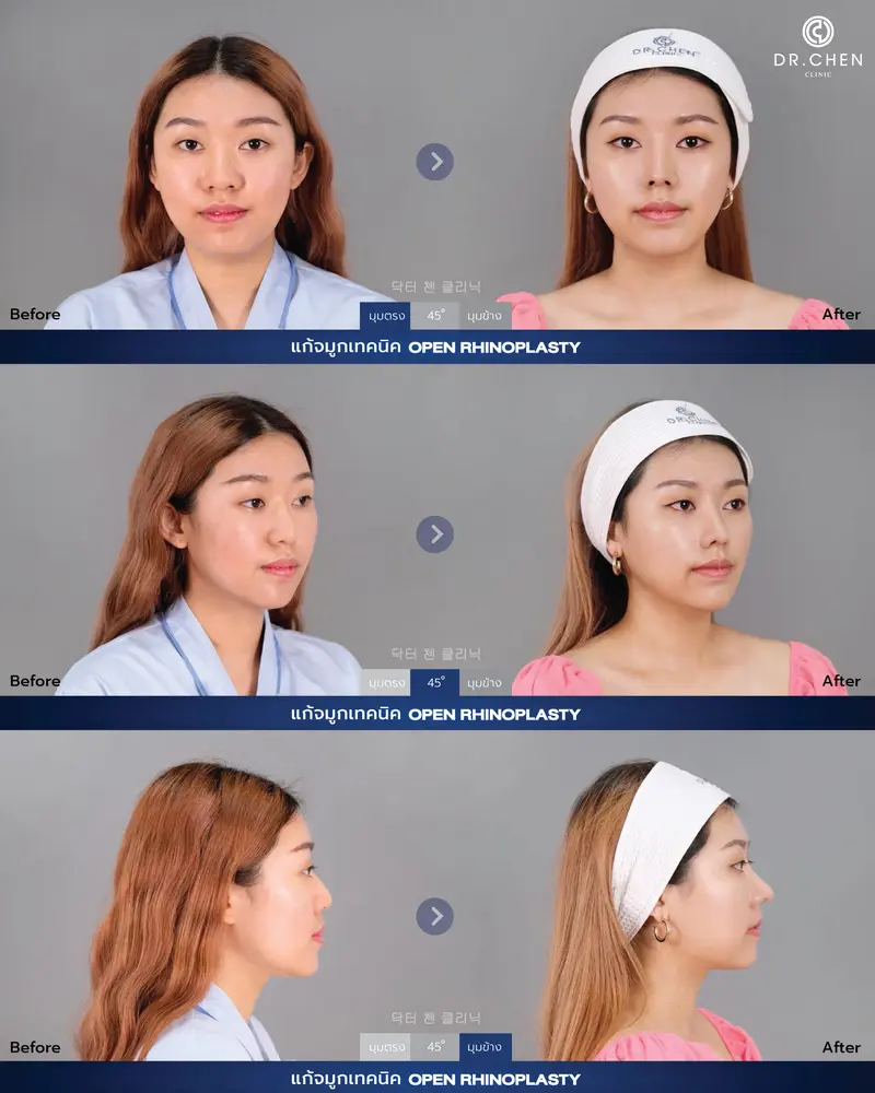 Revision Open Rhinoplasty