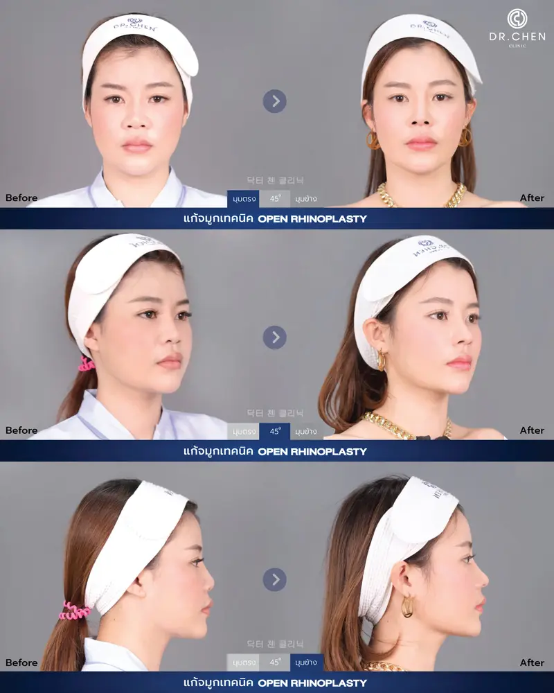 Revision Open Rhinoplasty