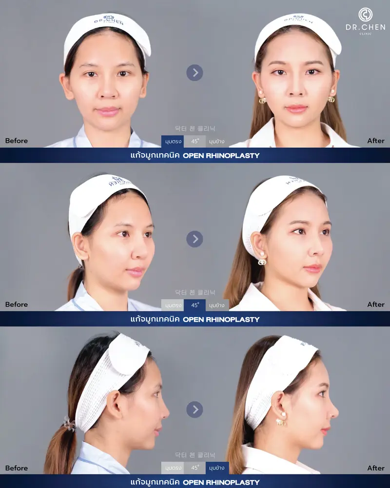 Revision Open Rhinoplasty