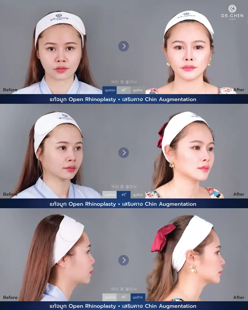 Revision Open Rhinoplasty