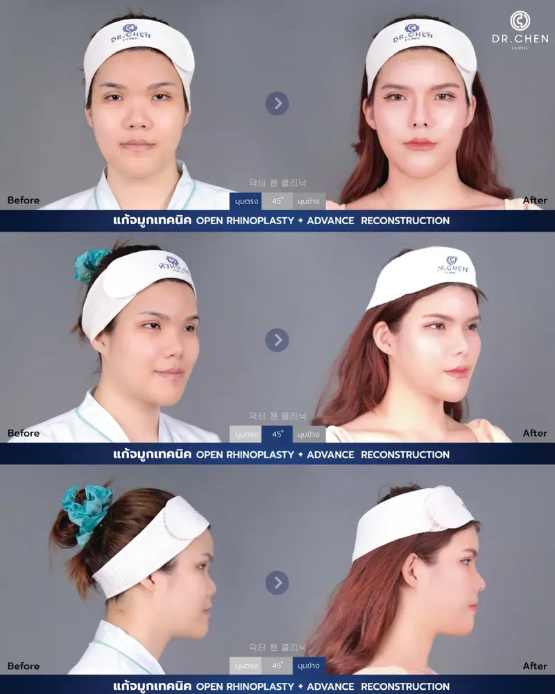 Revision Open Rhinoplasty