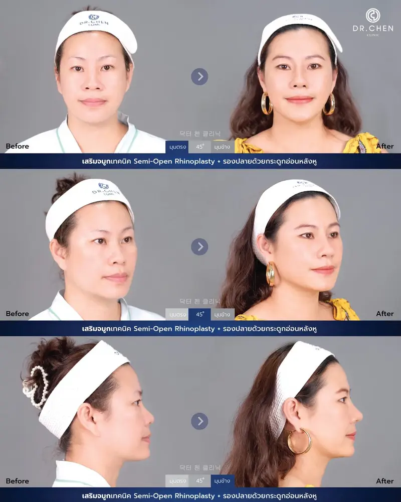 Semi-Open Rhinoplasty