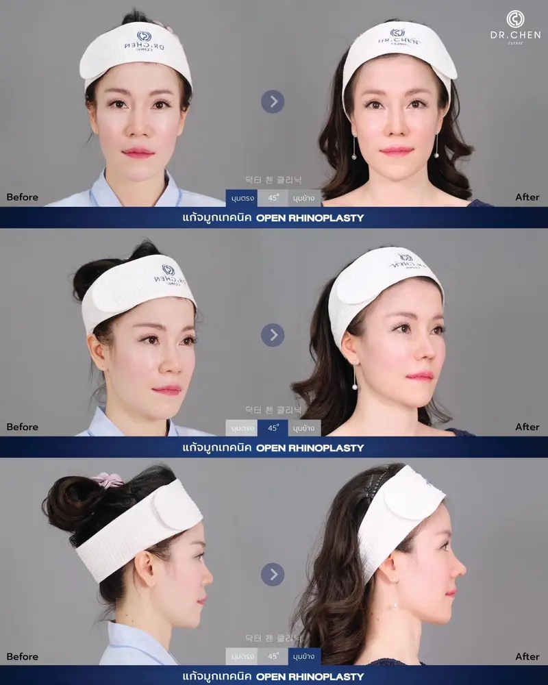 Revision Open Rhinoplasty