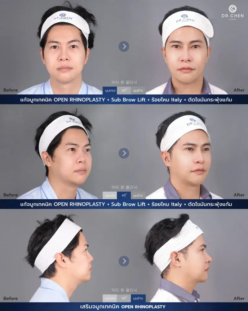 แก้จมูก Open Rhinoplasty