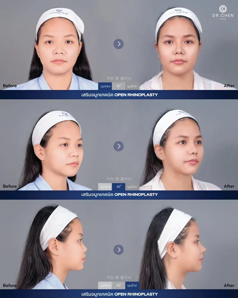 เสริมจมูก Open Rhinoplasty
