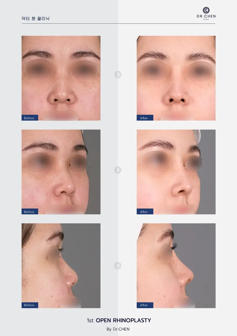 open Rhinoplasty