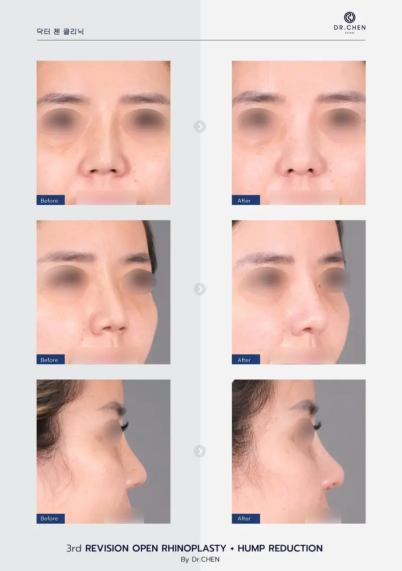 Revision Open Rhinoplasty