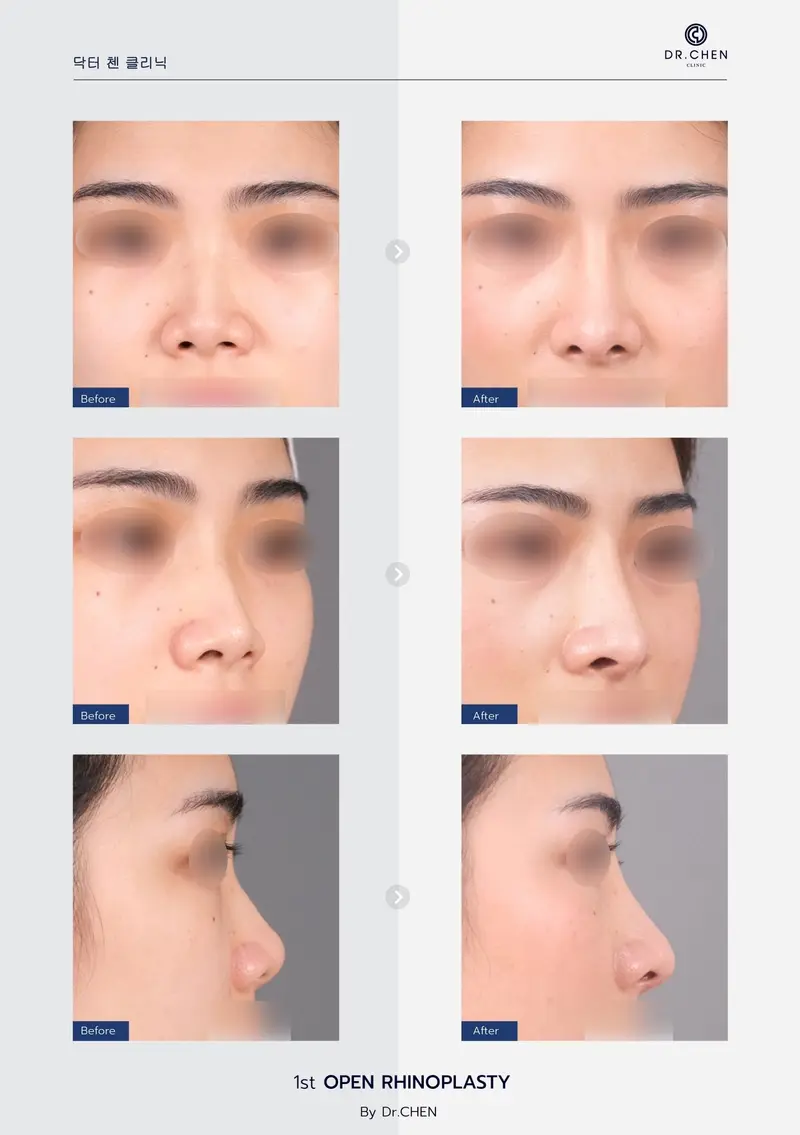 Open Rhinoplasty