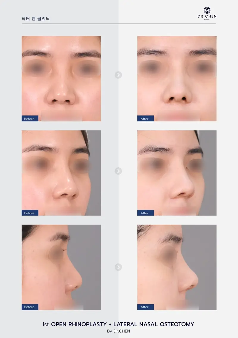 Open Rhinoplasty + Lateral nasal osteotomy