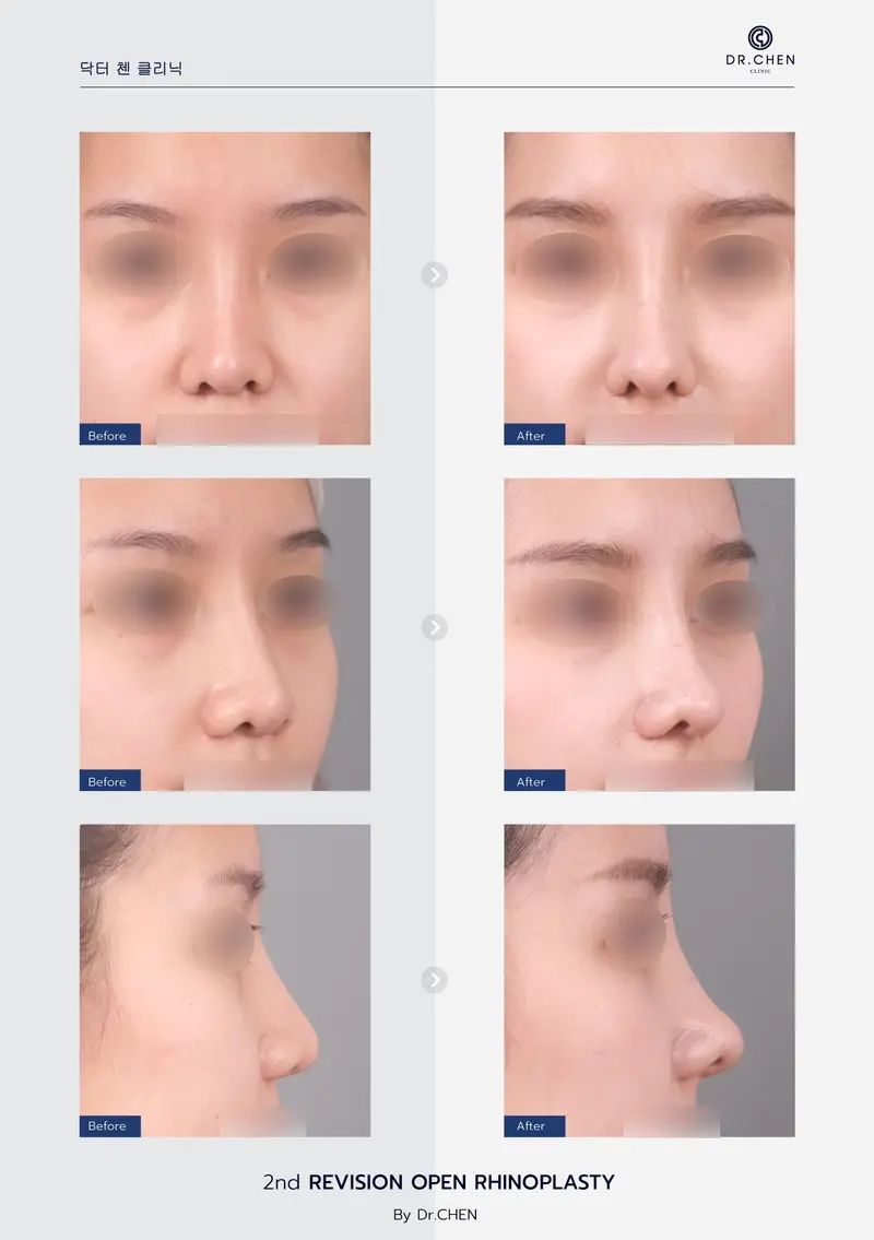 Revision Open Rhinoplasty