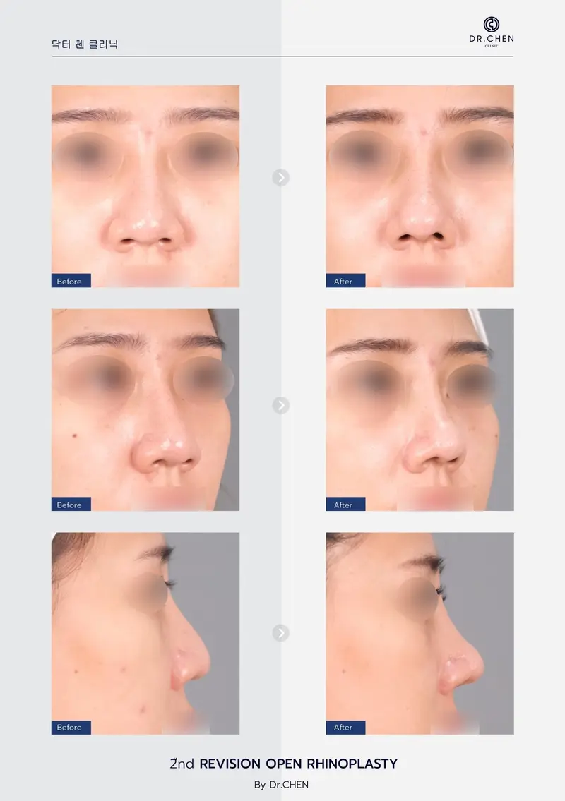 Revision Open Rhinoplasty