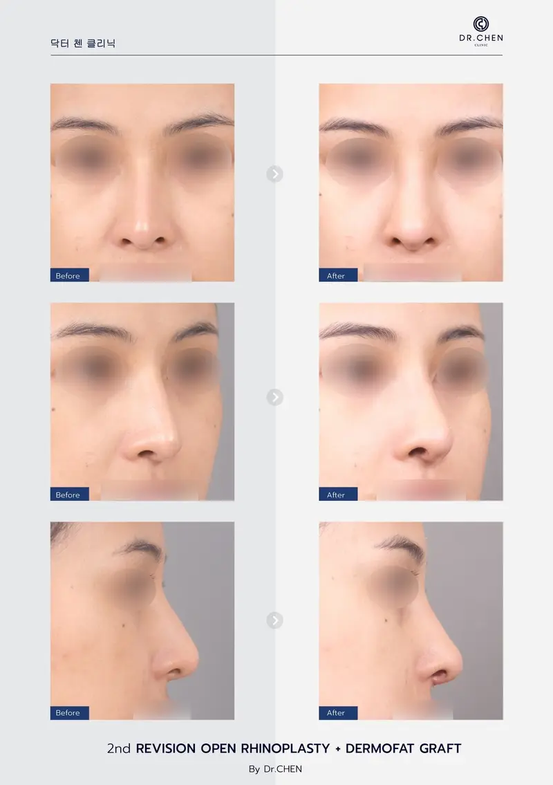 Revision Open Rhinoplasty