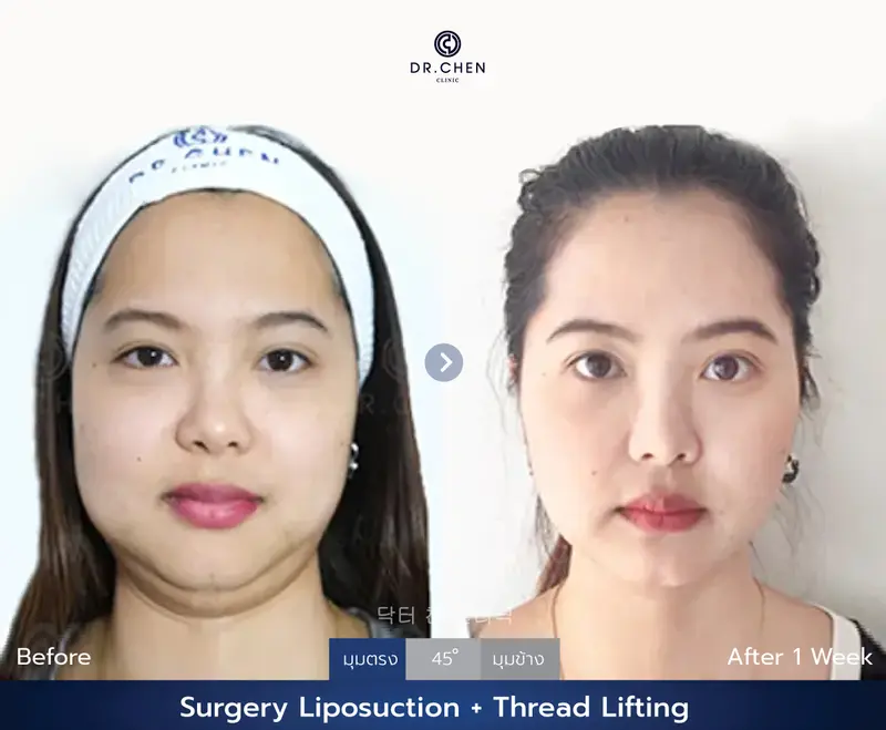 Liposuction Double Chin + Thread