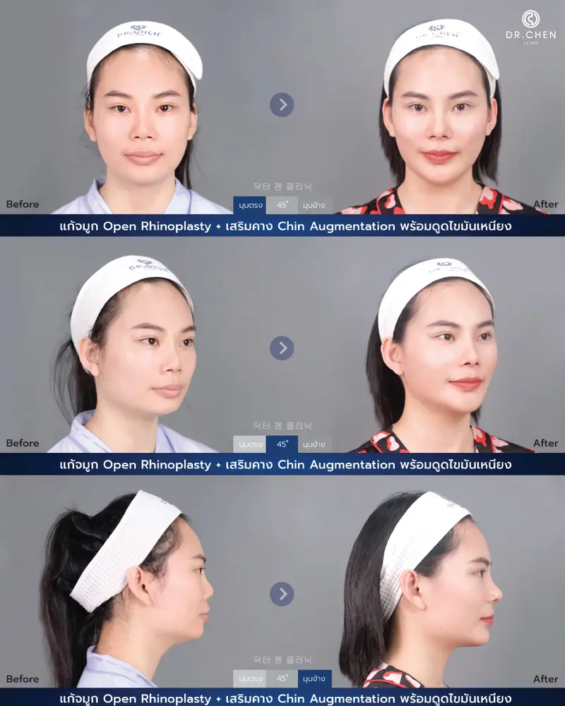 เสริมคาง Chin Augmentation