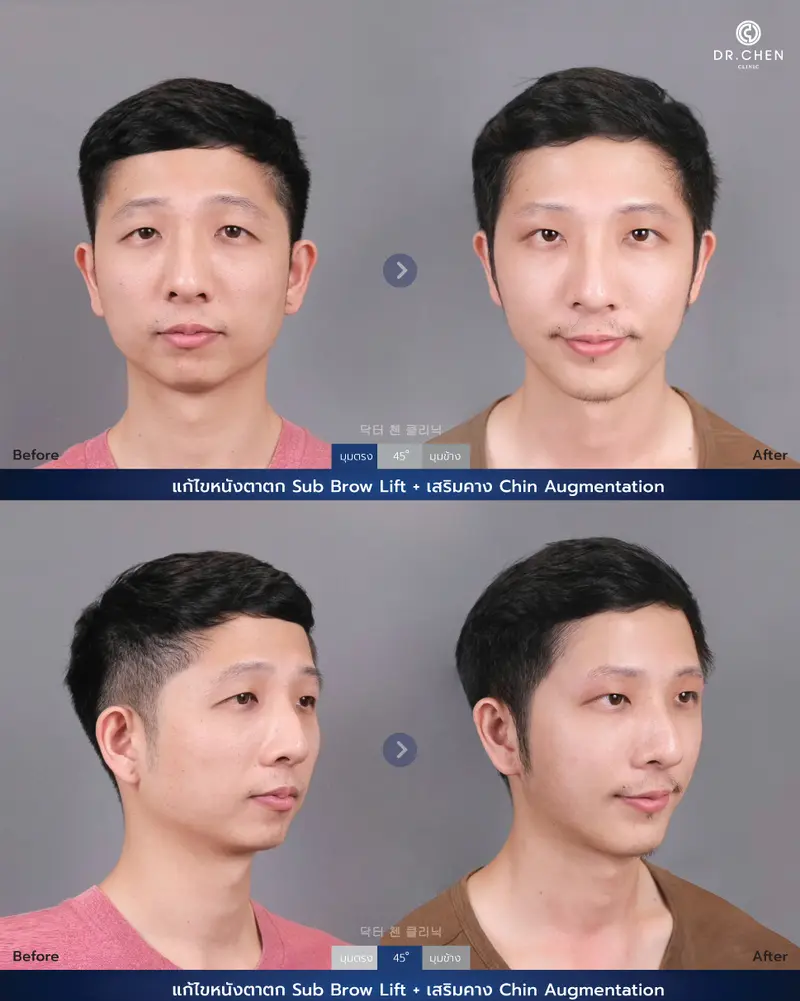 เสริมคาง Chin Augmentation