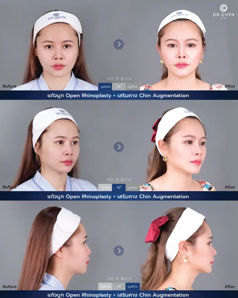 เสริมคาง Chin Augmentation