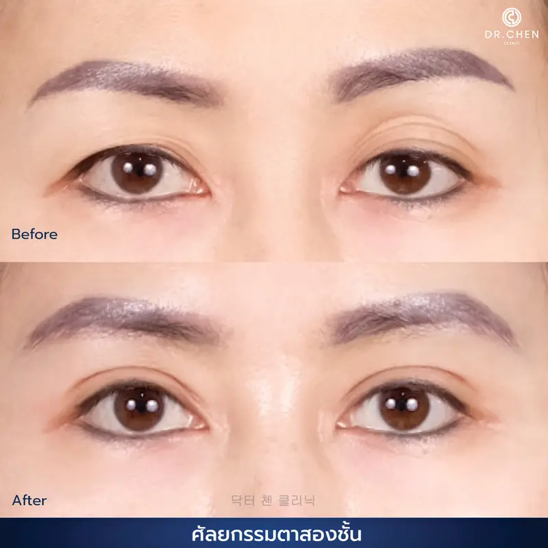 ศัลยกรรมตา