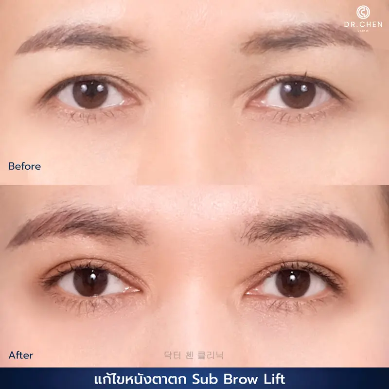 ศัลยกรรมตา