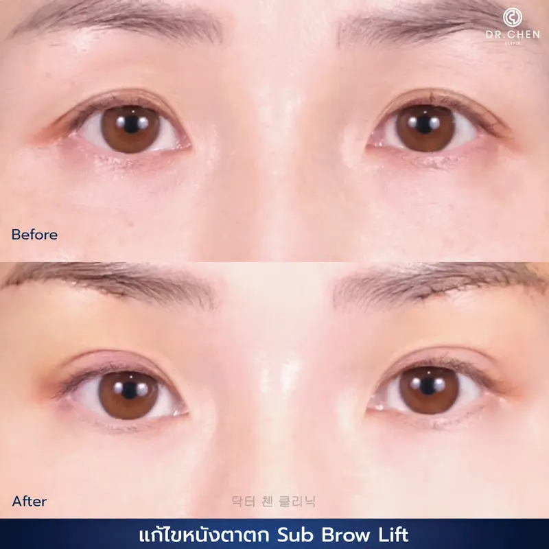 ศัลยกรรมตา