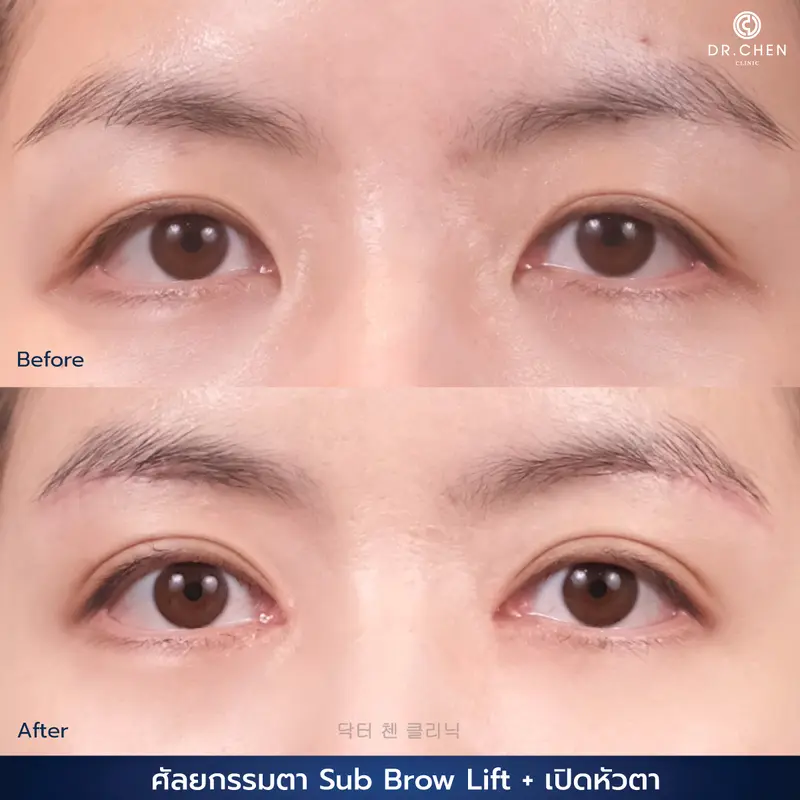 ศัลยกรรมตา